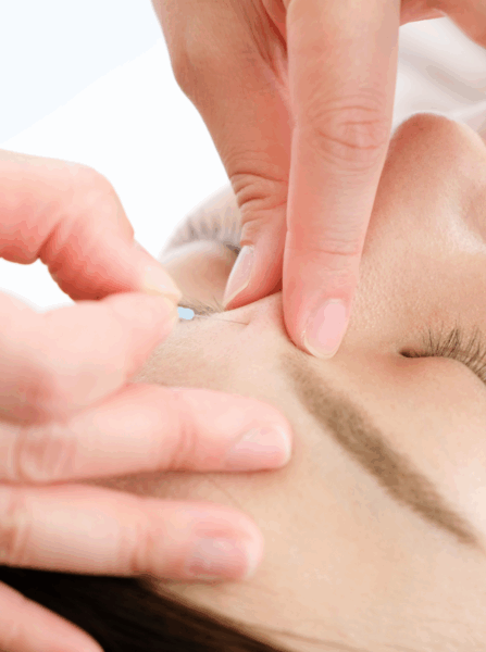 Dry Needling