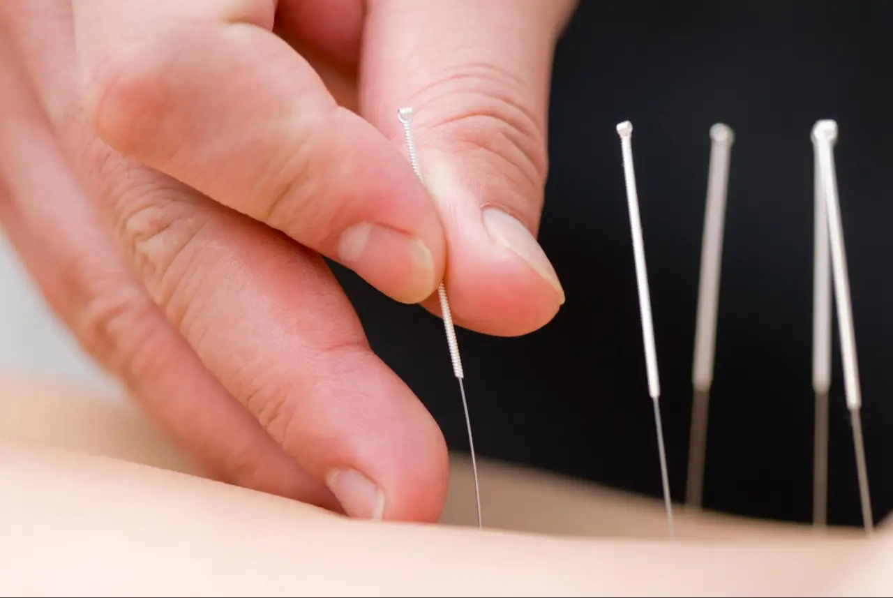 acupuncture in newmarket (2)
