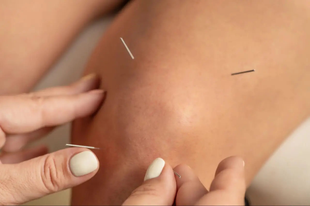 acupuncture newmarket (2)