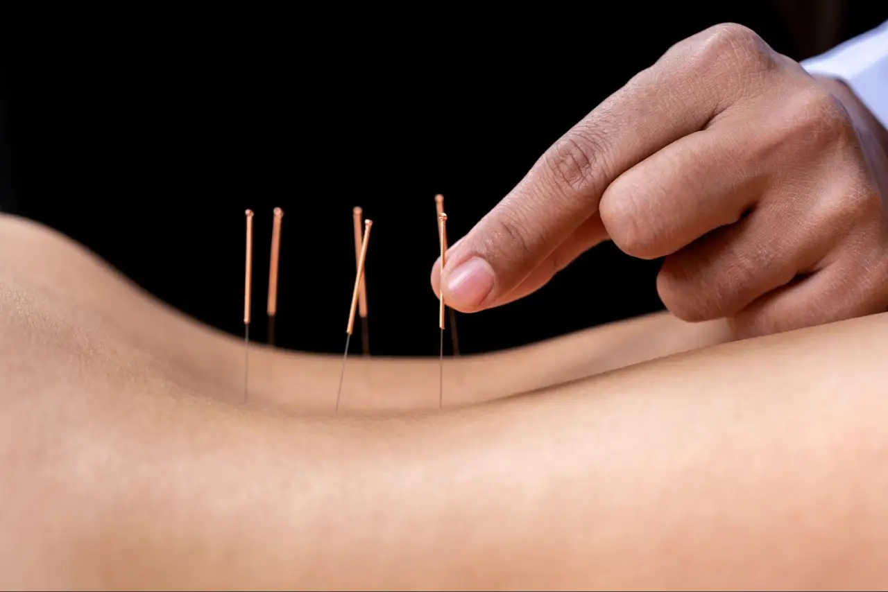 best acupuncture near me (3)