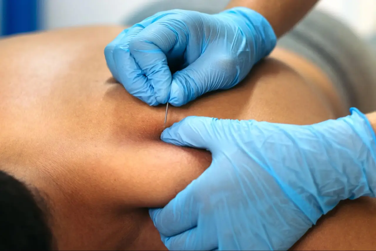 dry needling technique near me 