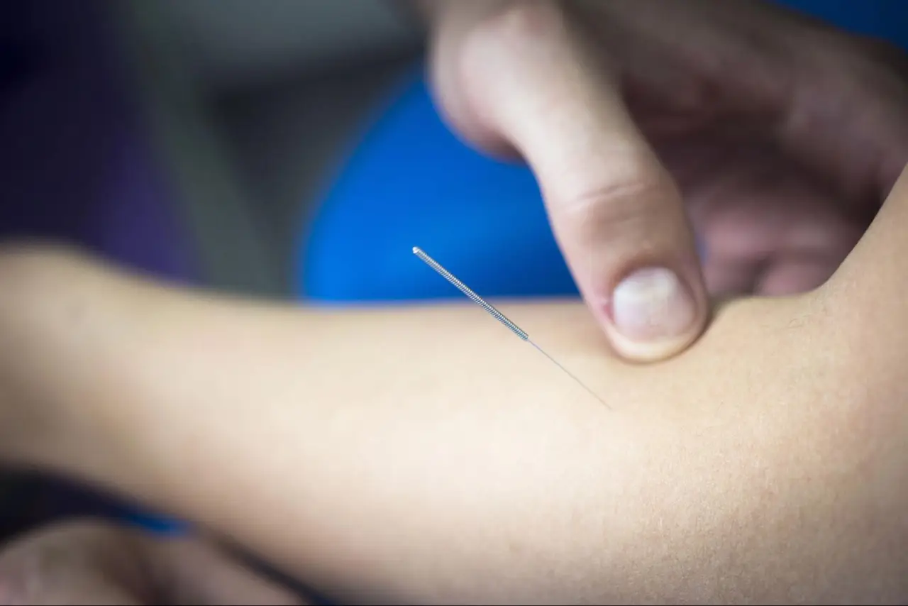 dry needling technique new market (1)