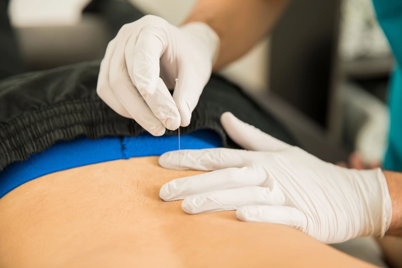 understanding dry needling vs acupuncture structural science needle anxiety newmarket