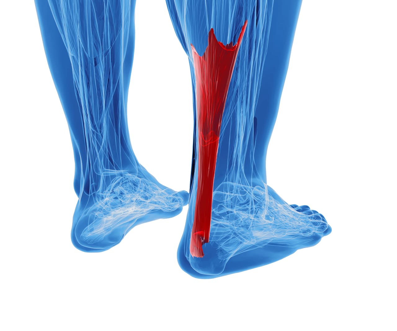 achilles tendonitis staying active